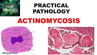 Practical Pathology ACTINOMYCOSIS [upl. by Kannry454]