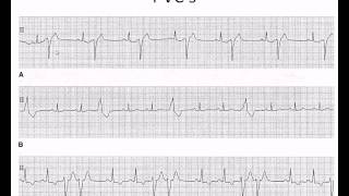 Easy EKG Premature Ventricular Contractions and Atrial Fibrillation [upl. by Anayhd]