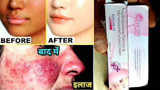 Elosone Ht Skin Cream Uses Or Side Effects In Hindi [upl. by Ennayllek938]