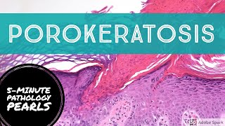 Porokeratosis 5Minute Pathology Pearls [upl. by Yanffit]