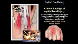 Sagittal Band Injury  Everything You Need To Know  Dr Nabil Ebraheim [upl. by Jarid]