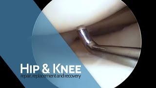 Arthroscopic Meniscus Repair [upl. by Laaspere627]