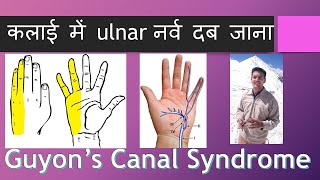 कलाई में ulnar नर्व दब जाना Guyons Canal Syndrome Hindi [upl. by Dorion227]